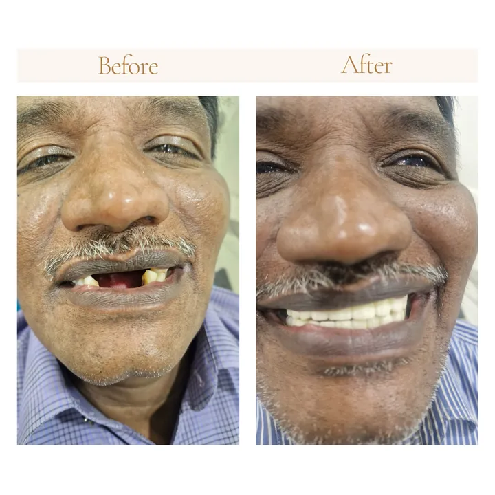 Before and after denture and crown restoration