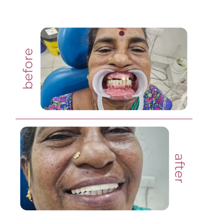 Before and after full denture treatment