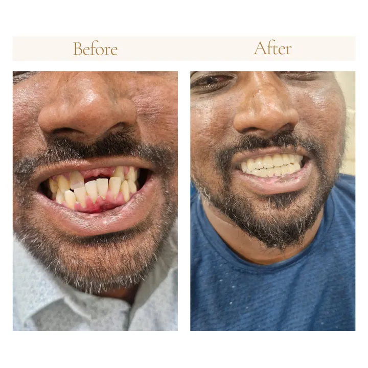 Before and after smile makeover