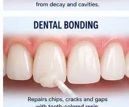Dental Bonding