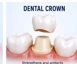 Dental Crown