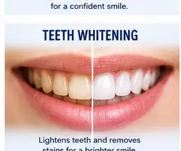 Teeth Whitening